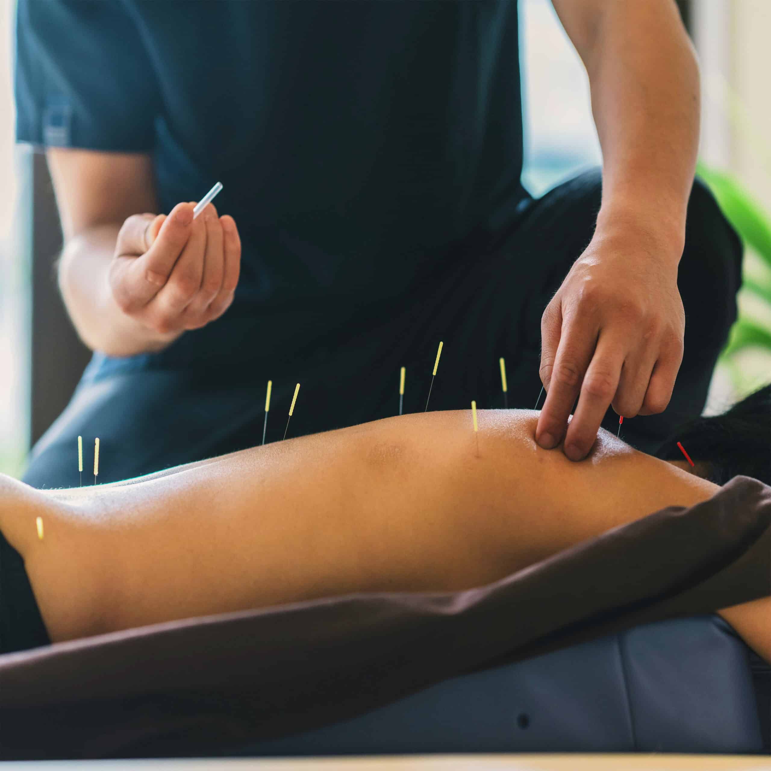Dry Needling Near Me. A skilled doctor expertly performs dry needling on a patient's back, in a serene therapy room, aiming to relieve muscle tension and promote healing.